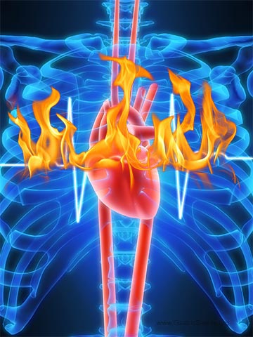 Also known as acid reflux, GERD is a condition in which the stomach 
