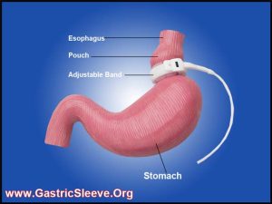 Gastric Sleeve vs Lap Band