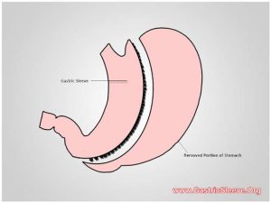 Gastric Sleeve Surgery