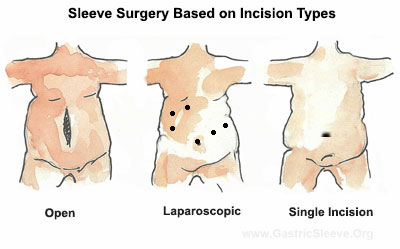 Single Incision Vs. Open and Laparoscopic Gastric Sleeve