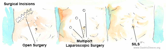 Incisions - SILS and Laparoscopic Sleeve Gastrectomy