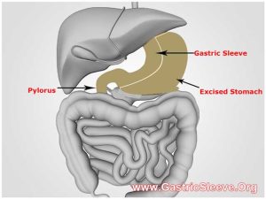 gastric-sleeve_2