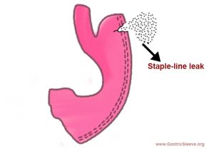 Gastric Sleeve Staple Line Leak