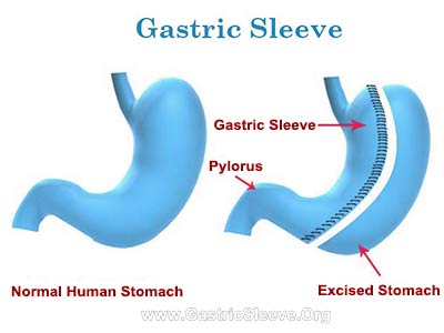 gastric sleeve surgery tips for success